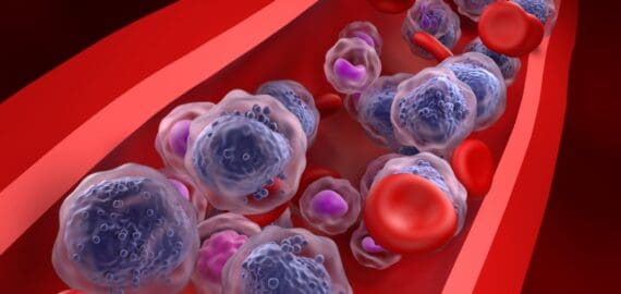 Leukemia Relapse Could Be Prevented by Disrupting Immune Signaling Mechanism